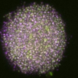 Glioblastoma