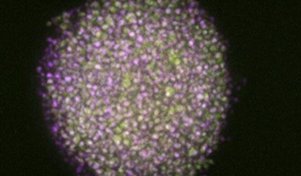 Glioblastoma GBM neurosphere